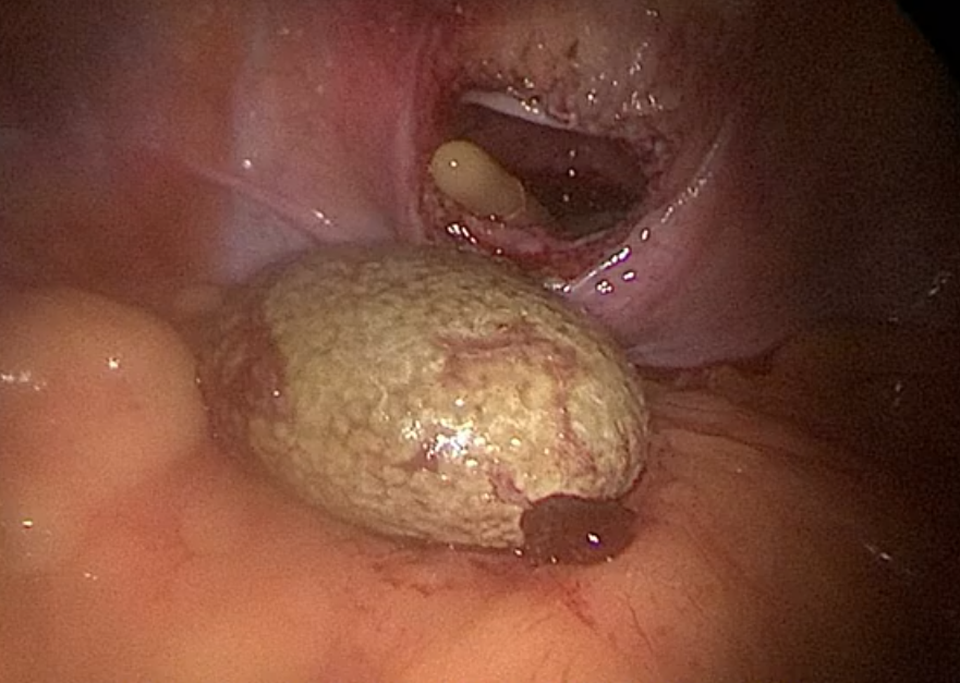 Viên sỏi như quả trứng gà trong bàng quang cậu bé 13 tuổi - 2