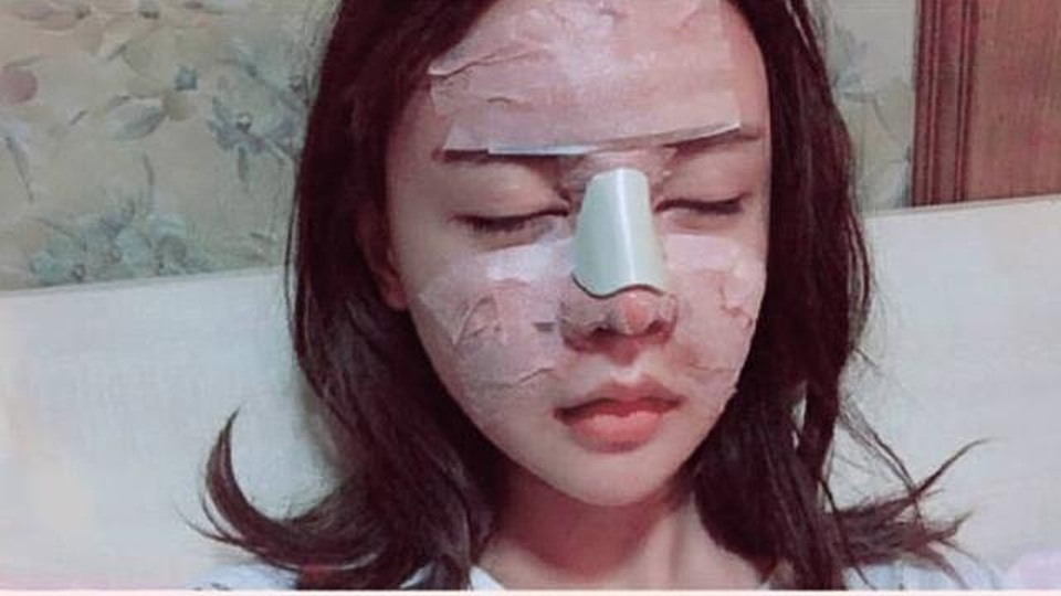 Cô gái Trung Quốc 20 tuổi phẫu thuật thẩm mỹ tổng cộng 33 lần - 3 Cô gái Trung Quốc 20 tuổi phẫu thuật thẩm mỹ tổng cộng 33 lần - 3