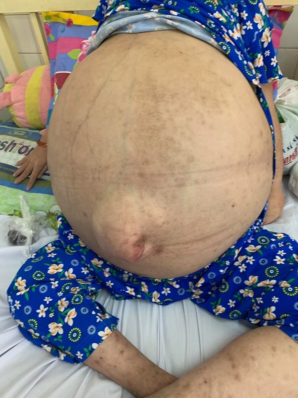 Nữ bệnh nhân 19 tuổi mang khối bướu khổng lồ như ễnh ương - 1 Nữ bệnh nhân 19 tuổi mang khối bướu khổng lồ như ễnh ương - 1