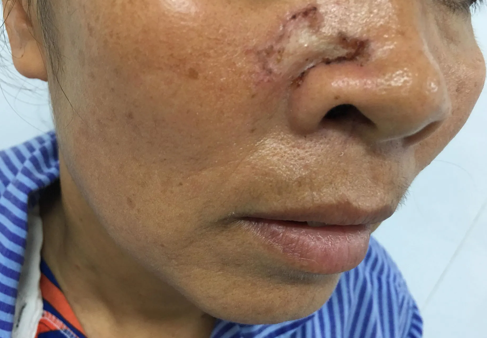 Nốt lạ trên da cảnh báo ung thư - 2 Nốt lạ trên da cảnh báo ung thư - 2