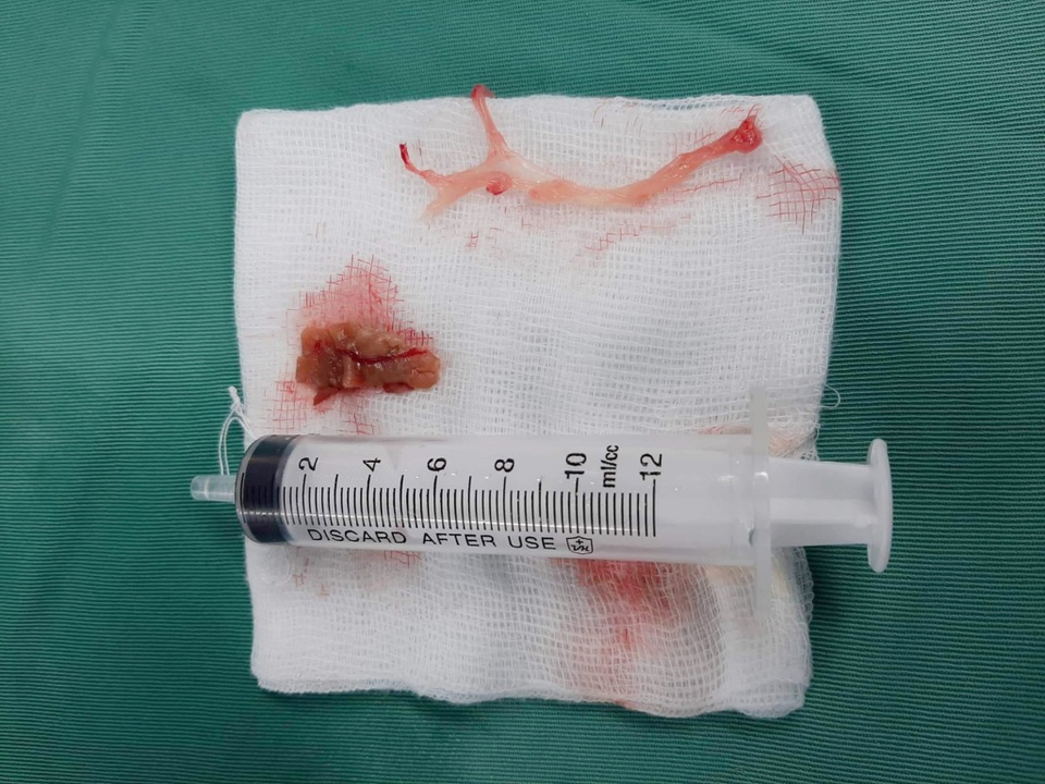 Hi hữu cô gái ăn thịt bò khô bị hóc sợi gân bò 5cm giữa thực quản - 1 Hi hữu cô gái ăn thịt bò khô bị hóc sợi gân bò 5cm giữa thực quản - 1