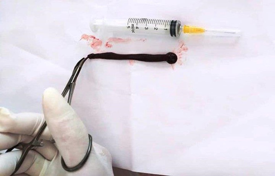 Uống nước khe, cháu bé 4 tuổi bị đỉa sống kí sinh trong mũi - 1 Uống nước khe, cháu bé 4 tuổi bị đỉa sống kí sinh trong mũi - 1