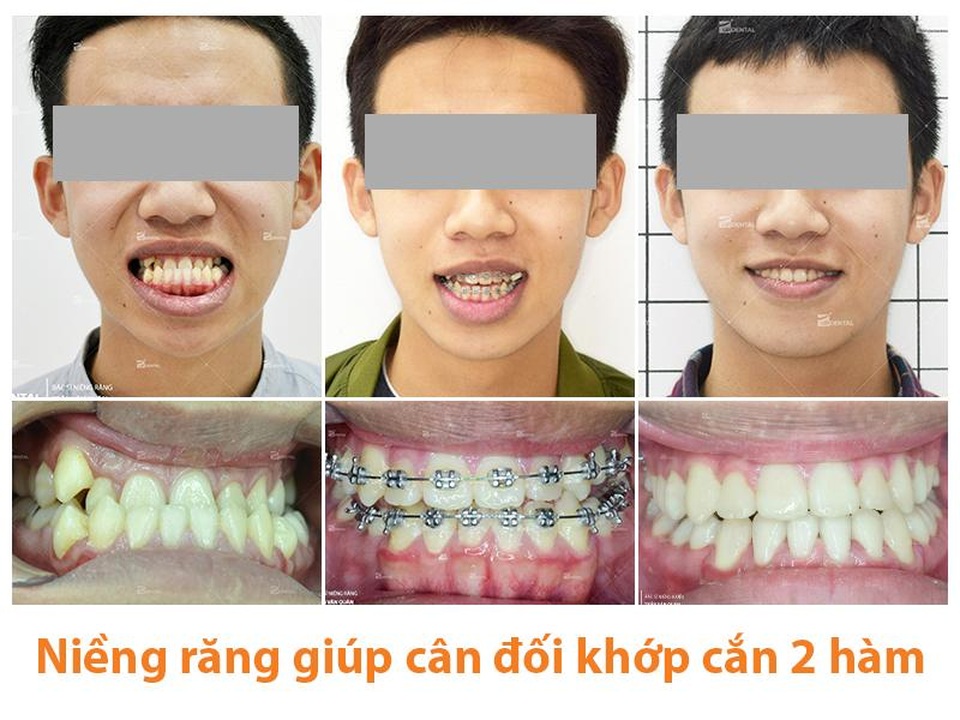 Niềng răng 1 hàm là gì? Có nên niềng răng 1 hàm không? - 2 Niềng răng 1 hàm là gì? Có nên niềng răng 1 hàm không? - 2