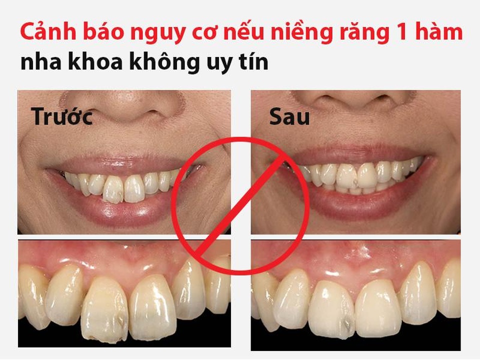 Niềng răng 1 hàm là gì? Có nên niềng răng 1 hàm không? - 3 Niềng răng 1 hàm là gì? Có nên niềng răng 1 hàm không? - 3