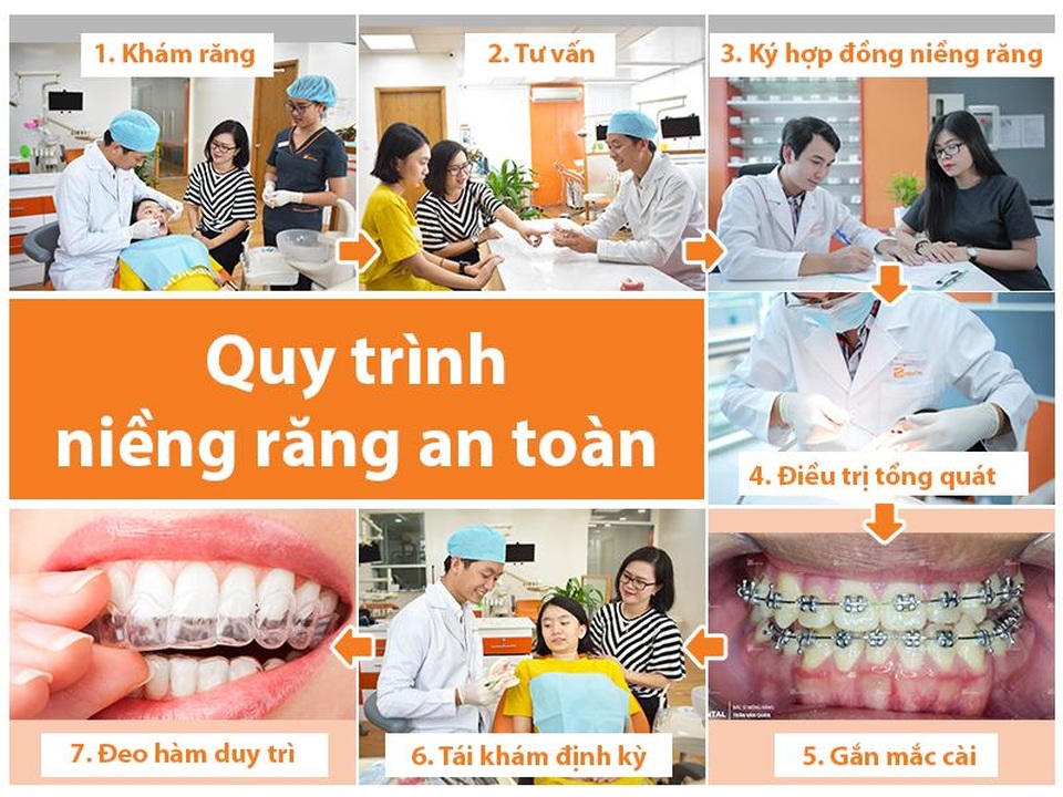 Niềng răng 1 hàm là gì? Có nên niềng răng 1 hàm không? - 4 Niềng răng 1 hàm là gì? Có nên niềng răng 1 hàm không? - 4