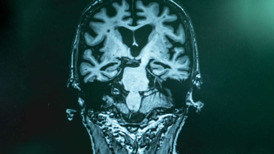 Xét nghiệm máu phát hiện bệnh Alzheimer ở ​​giai đoạn đầu với độ chính xác 94% - 1