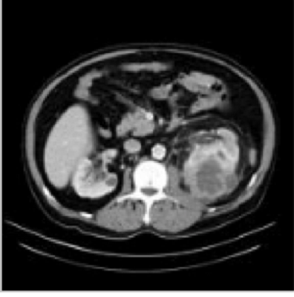 Trẻ bị sốt, đau vùng hông lưng coi chừng áp xe thận - 1 Trẻ bị sốt, đau vùng hông lưng coi chừng áp xe thận - 1