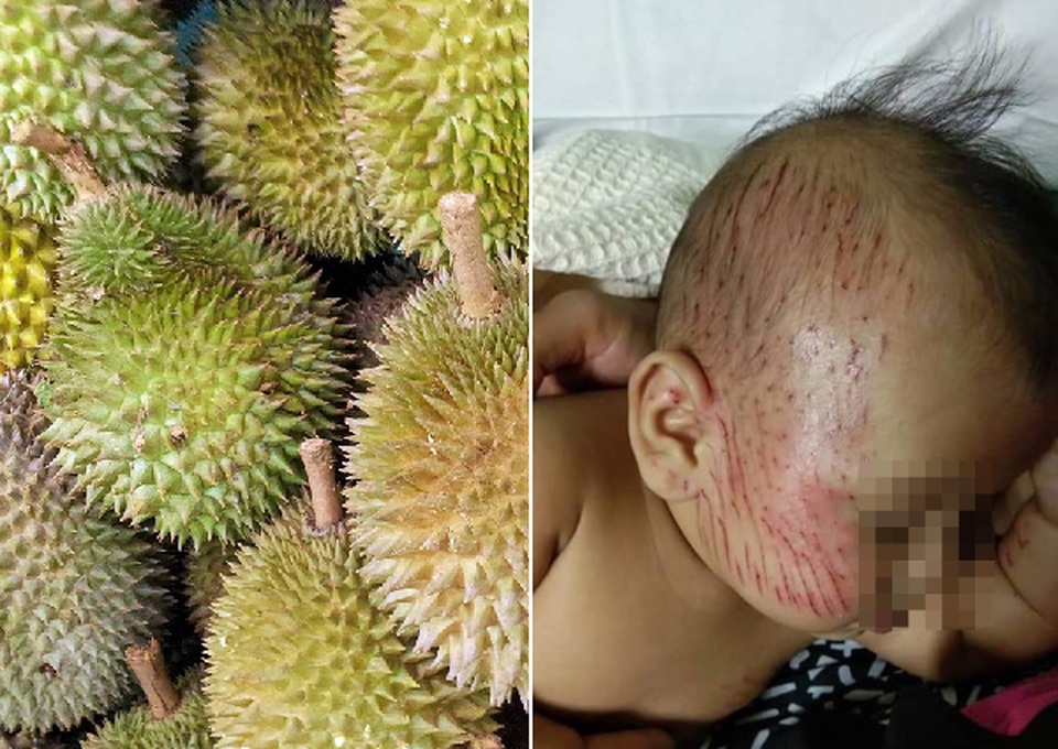 Tai nạn không tưởng: Bế con ra cửa, bất ngờ bị sầu riêng rơi trúng đầu - 1 Tai nạn không tưởng: Bế con ra cửa, bất ngờ bị sầu riêng rơi trúng đầu - 1