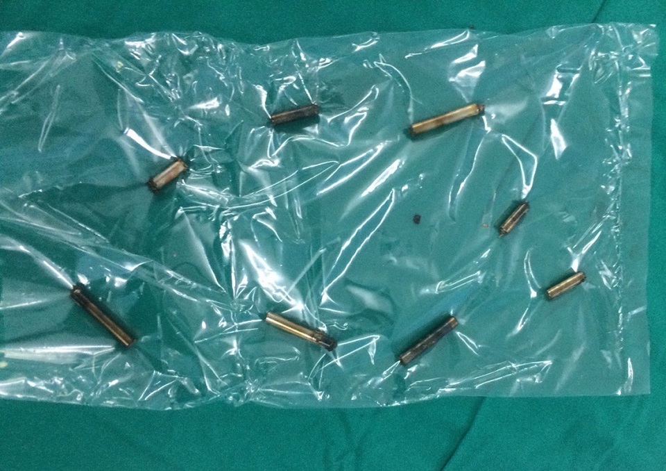 Bé trai bị thủng ruột vì 8 thanh nam châm xếp hình trong bụng - 2 Bé trai bị thủng ruột vì 8 thanh nam châm xếp hình trong bụng - 2