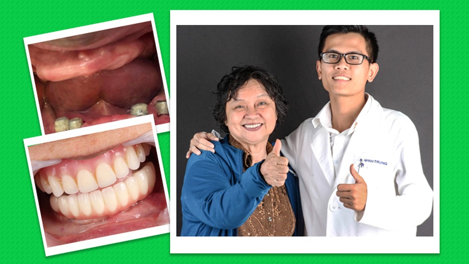 Cấy ghép Implant với máy gây tê không đau Dentalvibe - 2 Cấy ghép Implant với máy gây tê không đau Dentalvibe - 2