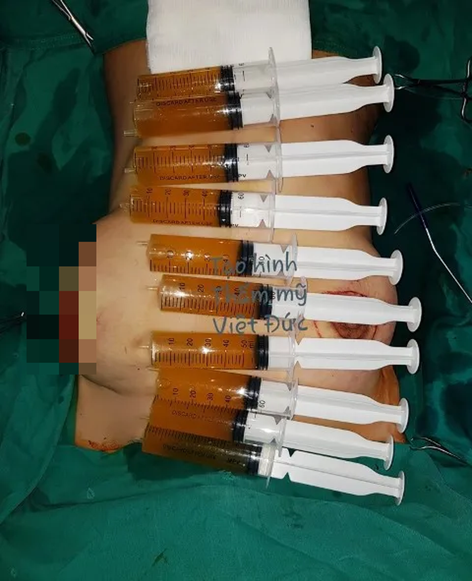 Bác sĩ “tháo ngòi” quả “bom ngực” như sắp nổ - 1 Bác sĩ “tháo ngòi” quả “bom ngực” như sắp nổ - 1