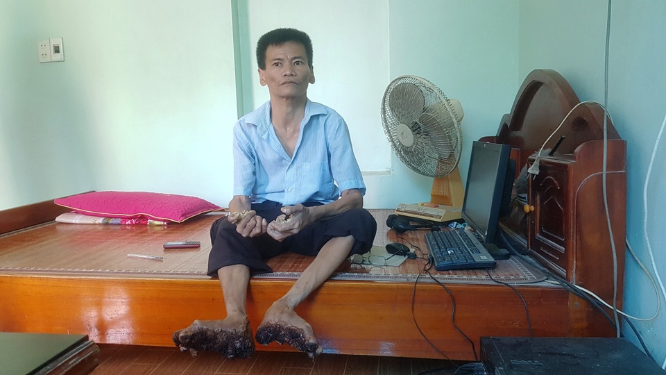Gặp người đầu tiên mắc căn bệnh kỳ lạ “người cây” ở Việt Nam - 1 Gặp người đầu tiên mắc căn bệnh kỳ lạ “người cây” ở Việt Nam - 1