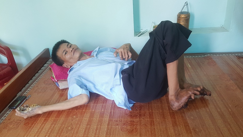 Gặp người đầu tiên mắc căn bệnh kỳ lạ “người cây” ở Việt Nam - 9 Gặp người đầu tiên mắc căn bệnh kỳ lạ “người cây” ở Việt Nam - 9