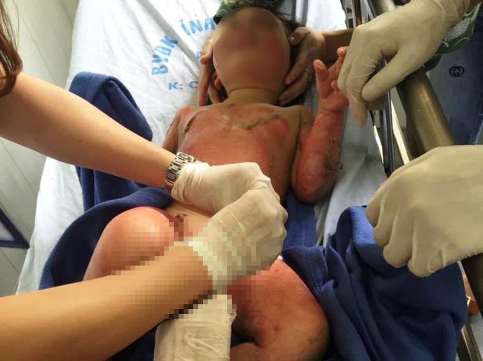 Bộ Giáo dục yêu cầu báo cáo về việc 3 trẻ mầm non bị bỏng trong lúc học kỹ năng thoát hiểm - 2 Bộ Giáo dục yêu cầu báo cáo về việc 3 trẻ mầm non bị bỏng trong lúc học kỹ năng thoát hiểm - 2