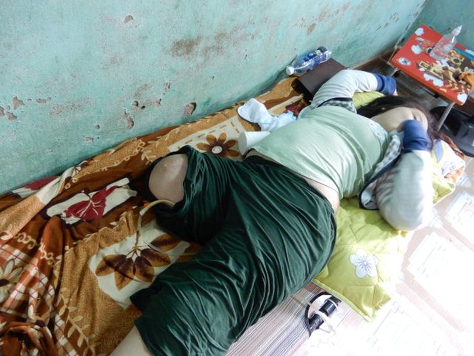 Bệnh u xương quái ác mang bé gái một chân đi mãi để lại những nỗi niềm day dứt cho bạn đọc Dân trí - 2 Bệnh u xương quái ác mang bé gái một chân đi mãi để lại những nỗi niềm day dứt cho bạn đọc Dân trí - 2