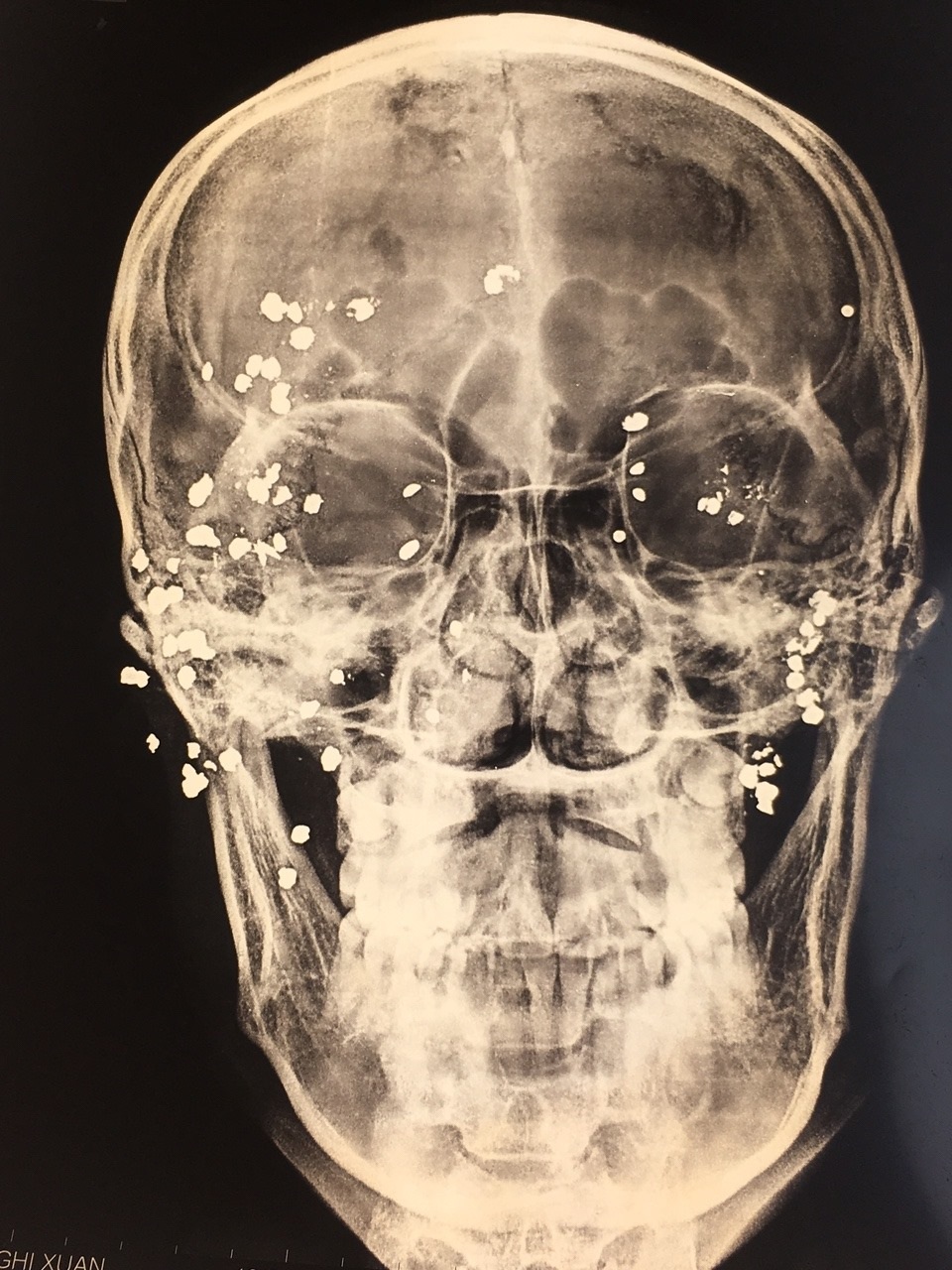 Hoảng hồn hình ảnh phim X-quang loé sáng gần 50 viên đạn hoa cà hoa cải găm khắp mặt bệnh nhân - 1 Hoảng hồn hình ảnh phim X-quang loé sáng gần 50 viên đạn hoa cà hoa cải găm khắp mặt bệnh nhân - 1