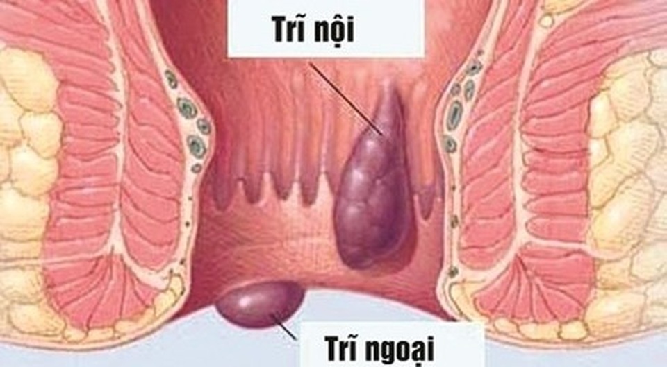 Bệnh trĩ điều trị như nào và công dụng của bộ sản phẩm Trĩ An Tâm - 1 Bệnh trĩ điều trị như nào và công dụng của bộ sản phẩm Trĩ An Tâm - 1