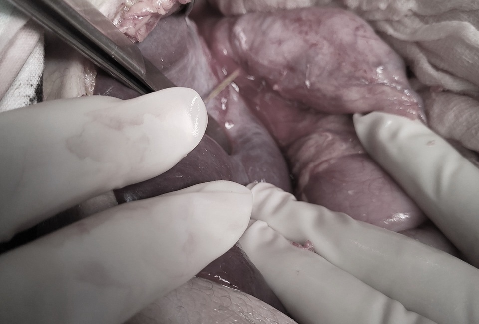 Sốc: Bệnh nhân 19 tuổi bị... tăm đâm xuyên gan, thủng tim - 1