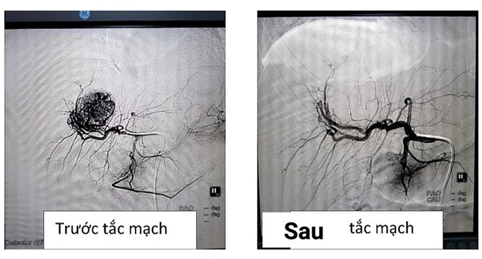 Bé 8 tuổi bị chảy máu nướu răng thường xuyên suốt 6 năm - 2 Bé 8 tuổi bị chảy máu nướu răng thường xuyên suốt 6 năm - 2
