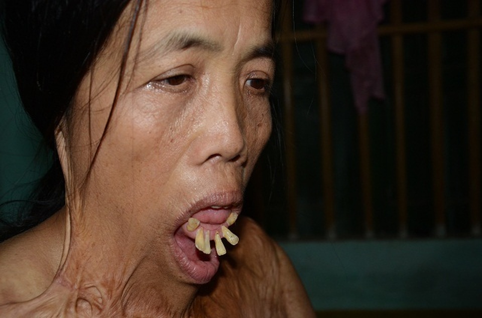 Viện Bỏng Quốc gia chữa miễn phí cho người đàn bà nửa thế kỉ mang hàm răng “kì dị” - 1 Viện Bỏng Quốc gia chữa miễn phí cho người đàn bà nửa thế kỉ mang hàm răng “kì dị” - 1