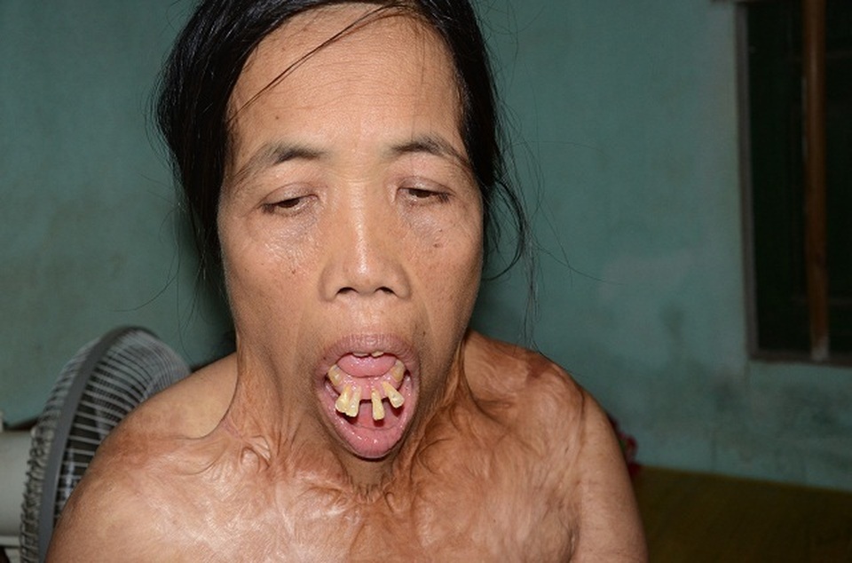 Viện Bỏng Quốc gia chữa miễn phí cho người đàn bà nửa thế kỉ mang hàm răng “kì dị” - 6 Viện Bỏng Quốc gia chữa miễn phí cho người đàn bà nửa thế kỉ mang hàm răng “kì dị” - 6