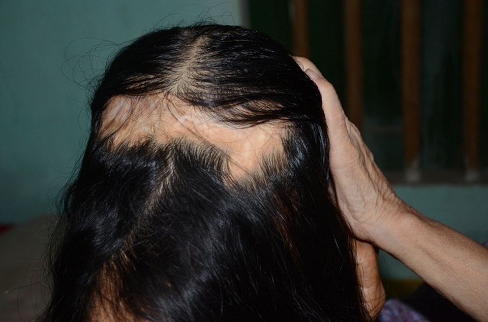 Viện Bỏng Quốc gia chữa miễn phí cho người đàn bà nửa thế kỉ mang hàm răng “kì dị” - 3 Viện Bỏng Quốc gia chữa miễn phí cho người đàn bà nửa thế kỉ mang hàm răng “kì dị” - 3