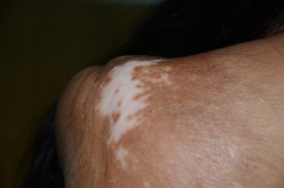 Viện Bỏng Quốc gia chữa miễn phí cho người đàn bà nửa thế kỉ mang hàm răng “kì dị” - 4 Viện Bỏng Quốc gia chữa miễn phí cho người đàn bà nửa thế kỉ mang hàm răng “kì dị” - 4