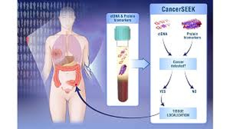 CancerSEEK: “Sinh thiết lỏng” chẩn đoán sớm ung thư - 1 CancerSEEK: “Sinh thiết lỏng” chẩn đoán sớm ung thư - 1