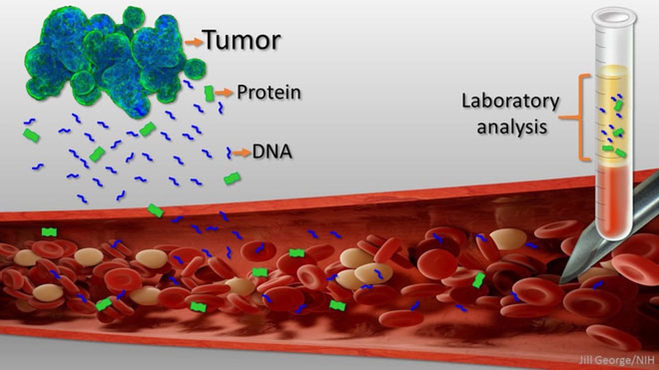 CancerSEEK: “Sinh thiết lỏng” chẩn đoán sớm ung thư - 2 CancerSEEK: “Sinh thiết lỏng” chẩn đoán sớm ung thư - 2