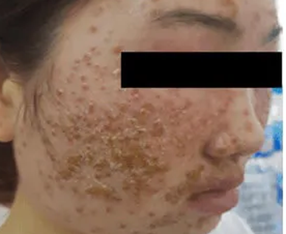 Sốc với mảng mụn chi chít trên mặt cô gái sau dùng bột rửa mặt mua online - 1 Sốc với mảng mụn chi chít trên mặt cô gái sau dùng bột rửa mặt mua online - 1
