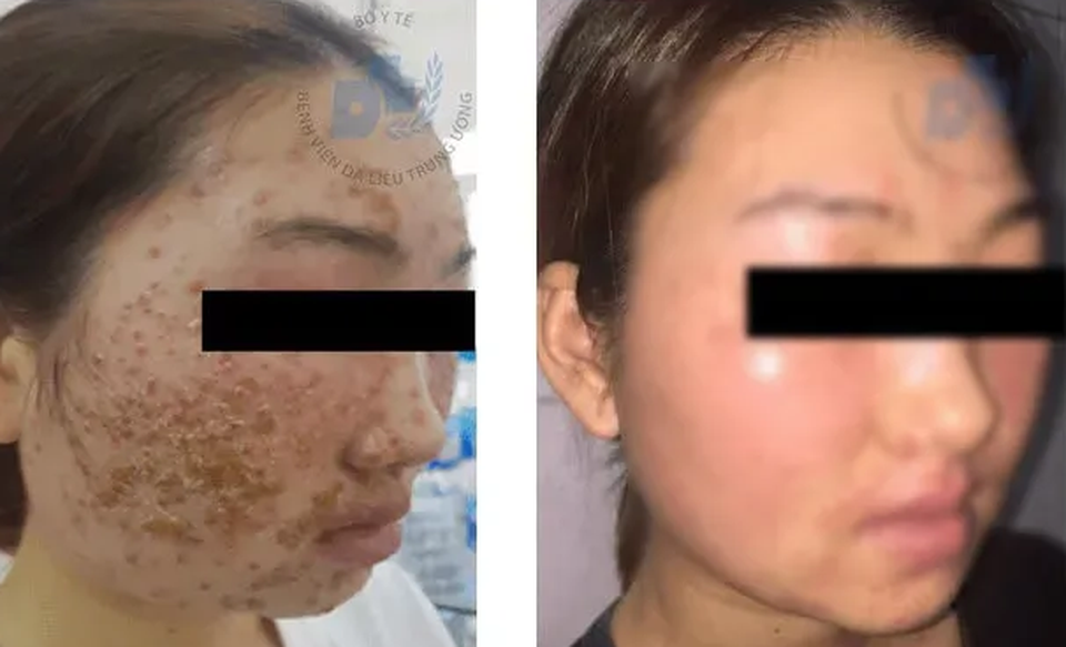 Sốc với mảng mụn chi chít trên mặt cô gái sau dùng bột rửa mặt mua online - 2 Sốc với mảng mụn chi chít trên mặt cô gái sau dùng bột rửa mặt mua online - 2
