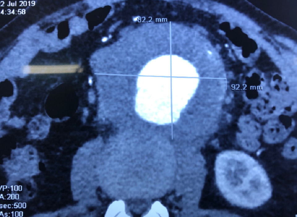 Bác sĩ hoảng hốt phát hiện “quả bom nổ chậm” trong bụng bệnh nhân - 1 Bác sĩ hoảng hốt phát hiện “quả bom nổ chậm” trong bụng bệnh nhân - 1
