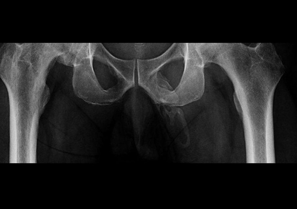 Bệnh nhân kì lạ có cậu nhỏ đang biến thành… xương - 1