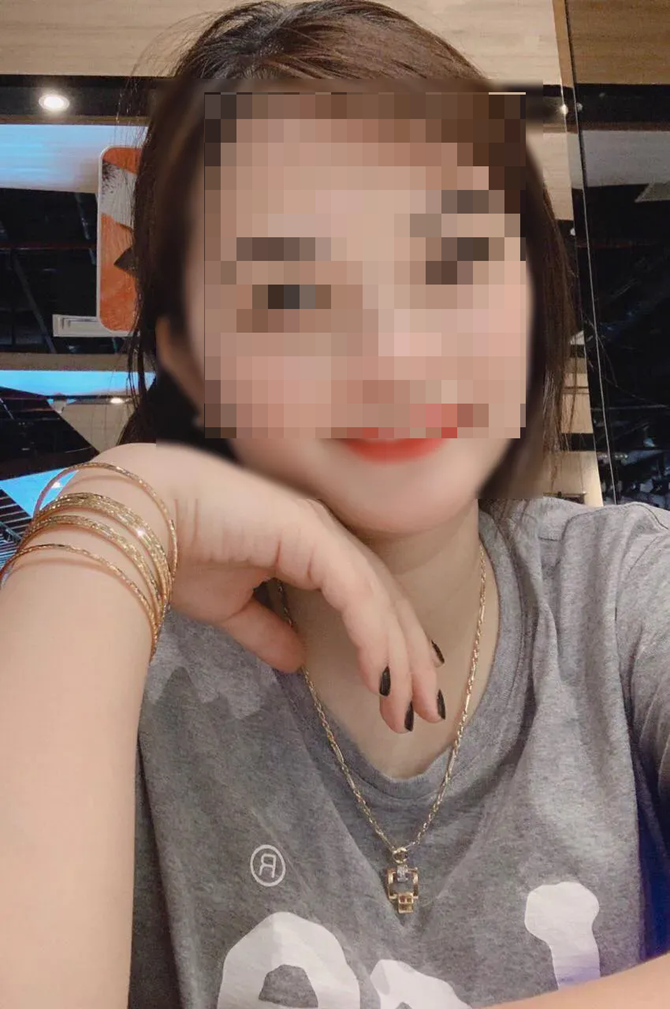 Sốc: Cô gái xinh đẹp mặt biến dạng, chi chít lỗ rò mủ sau 2 mũi tiêm mỡ tự thân - 1 Sốc: Cô gái xinh đẹp mặt biến dạng, chi chít lỗ rò mủ sau 2 mũi tiêm mỡ tự thân - 1