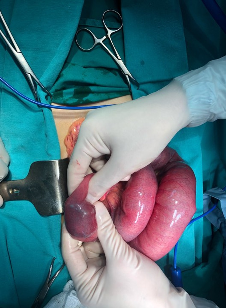 Nam thanh niên bị tắc ruột nghi do đam mê món... trà sữa - 1 Nam thanh niên bị tắc ruột nghi do đam mê món... trà sữa - 1