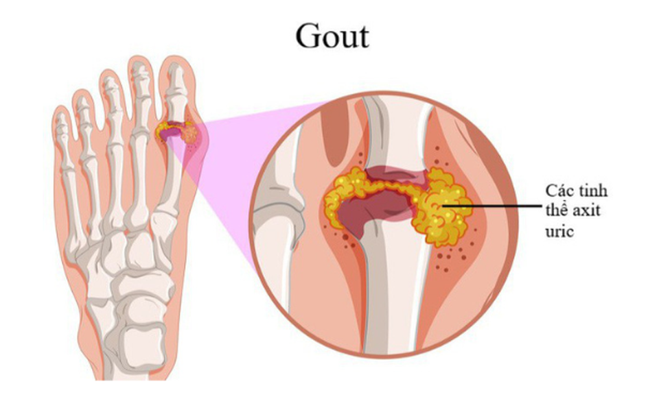 Suy giảm sinh lý vì bị gout, phải làm sao? - 1 Suy giảm sinh lý vì bị gout, phải làm sao? - 1