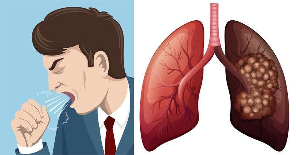 U phổi – Căn bệnh có xu hướng ngày càng tăng nhanh trên toàn cầu - 2 U phổi – Căn bệnh có xu hướng ngày càng tăng nhanh trên toàn cầu - 2