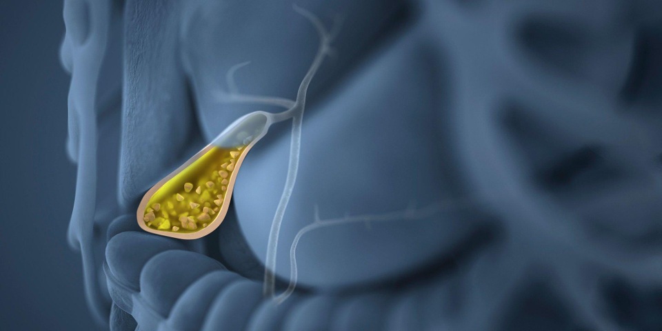 Bị sỏi mật đau ở đâu? Nhận biết sớm bằng cách nào? - 2 Bị sỏi mật đau ở đâu? Nhận biết sớm bằng cách nào? - 2