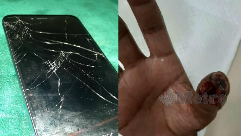 Suýt mất ngón tay vì sử dụng smartphone với tấm dán cường lực màn hình bị vỡ - 1 Suýt mất ngón tay vì sử dụng smartphone với tấm dán cường lực màn hình bị vỡ - 1