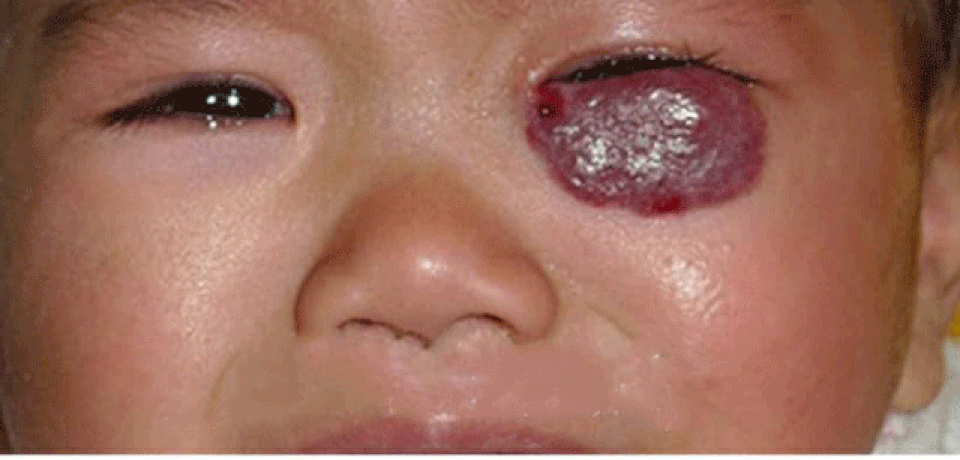 U máu và phương pháp điều trị triệt để, an toàn - 1 U máu và phương pháp điều trị triệt để, an toàn - 1