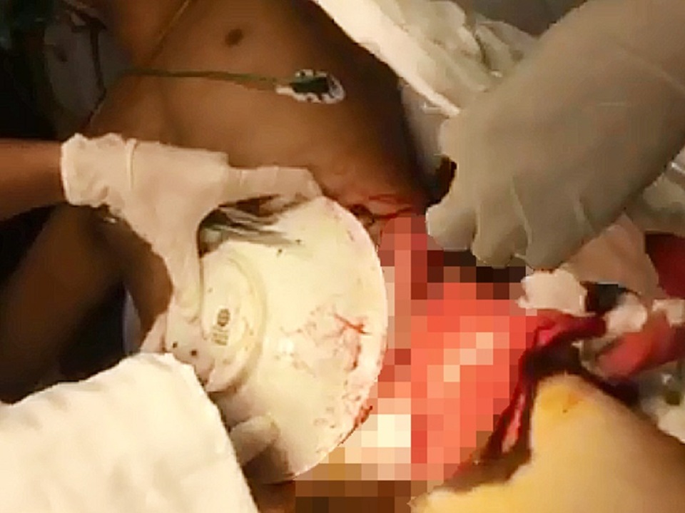 Rách toạc bụng, lòi ruột vì lưỡi cưa văng trúng - 1 Rách toạc bụng, lòi ruột vì lưỡi cưa văng trúng - 1