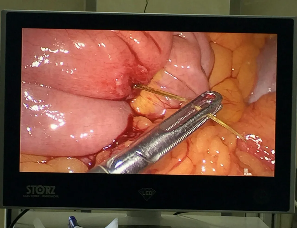 Bệnh nhân bị xương cá đâm thủng ruột vì trì hoãn can thiệp đợi... tự tiêu - 1 Bệnh nhân bị xương cá đâm thủng ruột vì trì hoãn can thiệp đợi... tự tiêu - 1