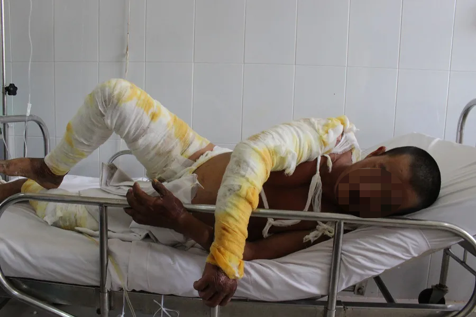 Liều mình dập đám cháy trong công ty, nam công nhân bị bỏng nặng - 1 Liều mình dập đám cháy trong công ty, nam công nhân bị bỏng nặng - 1