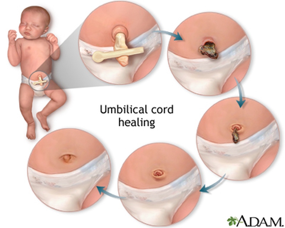 Chăm sóc rốn cho trẻ sơ sinh: Chuyện nhỏ nhưng không nhỏ! - 2 Chăm sóc rốn cho trẻ sơ sinh: Chuyện nhỏ nhưng không nhỏ! - 2