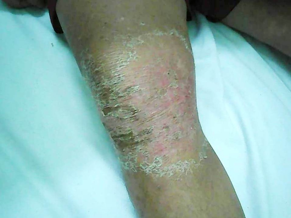 Đầu gối sưng rộp vì đắp lá cây lạ Đầu gối sưng rộp vì đắp lá cây lạ