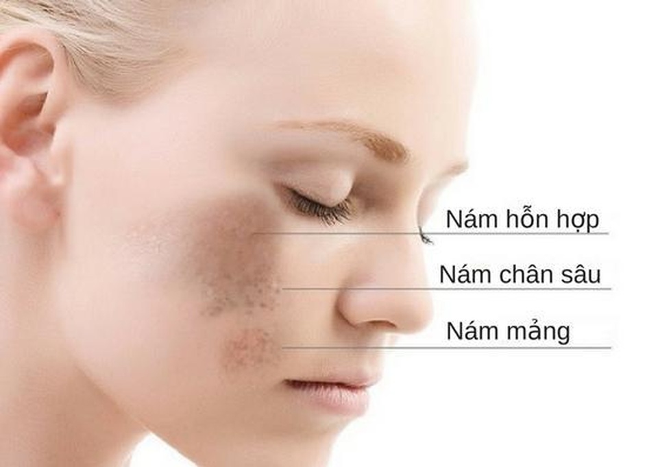 Merawhite - Bí quyết giúp chị em xua tan nỗi lo nám da - 1 Merawhite - Bí quyết giúp chị em xua tan nỗi lo nám da - 1