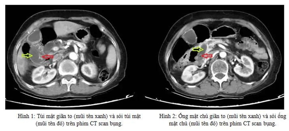 Cảnh giác với biểu hiện đau bụng ở người cao tuổi - 1 Cảnh giác với biểu hiện đau bụng ở người cao tuổi - 1