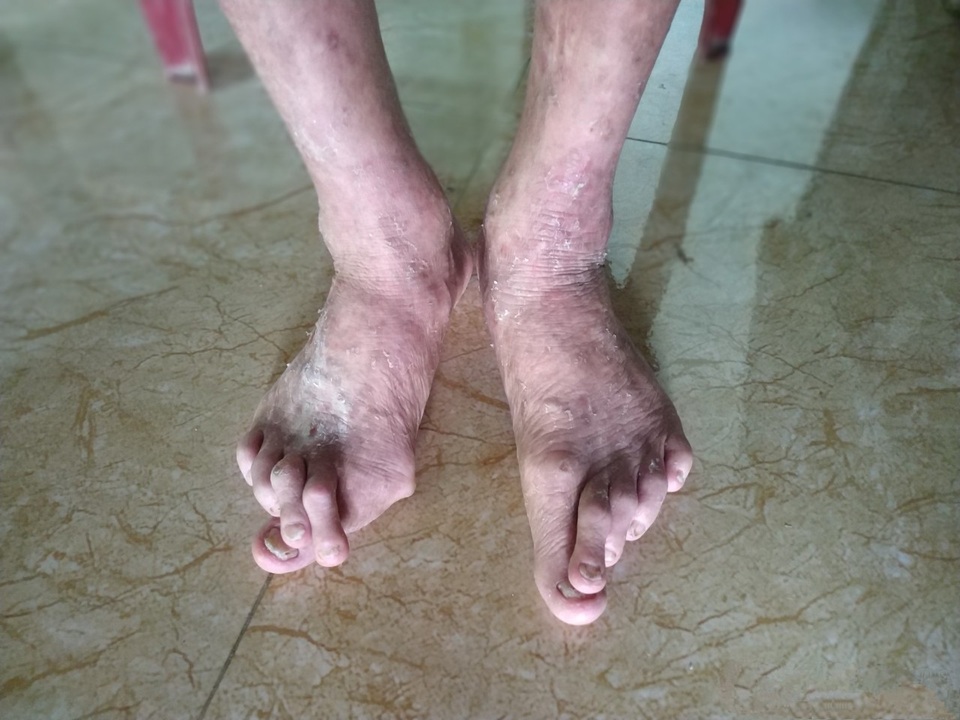 Vết gợn gia đình da cam sống quay quắt với cả tá bệnh hiểm nghèo - 4