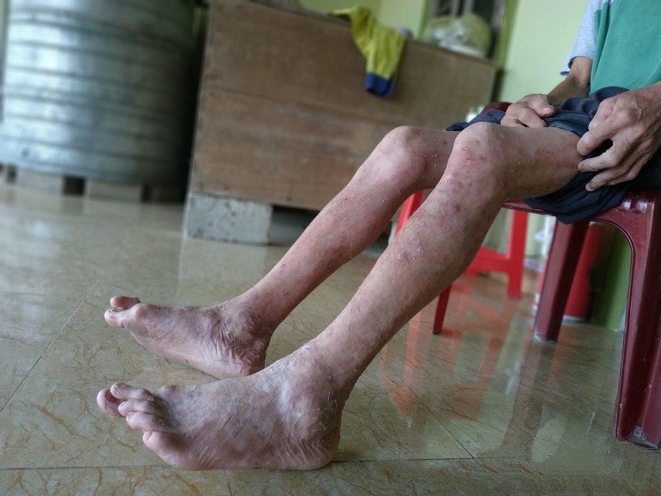 Vết gợn gia đình da cam sống quay quắt với cả tá bệnh hiểm nghèo - 5