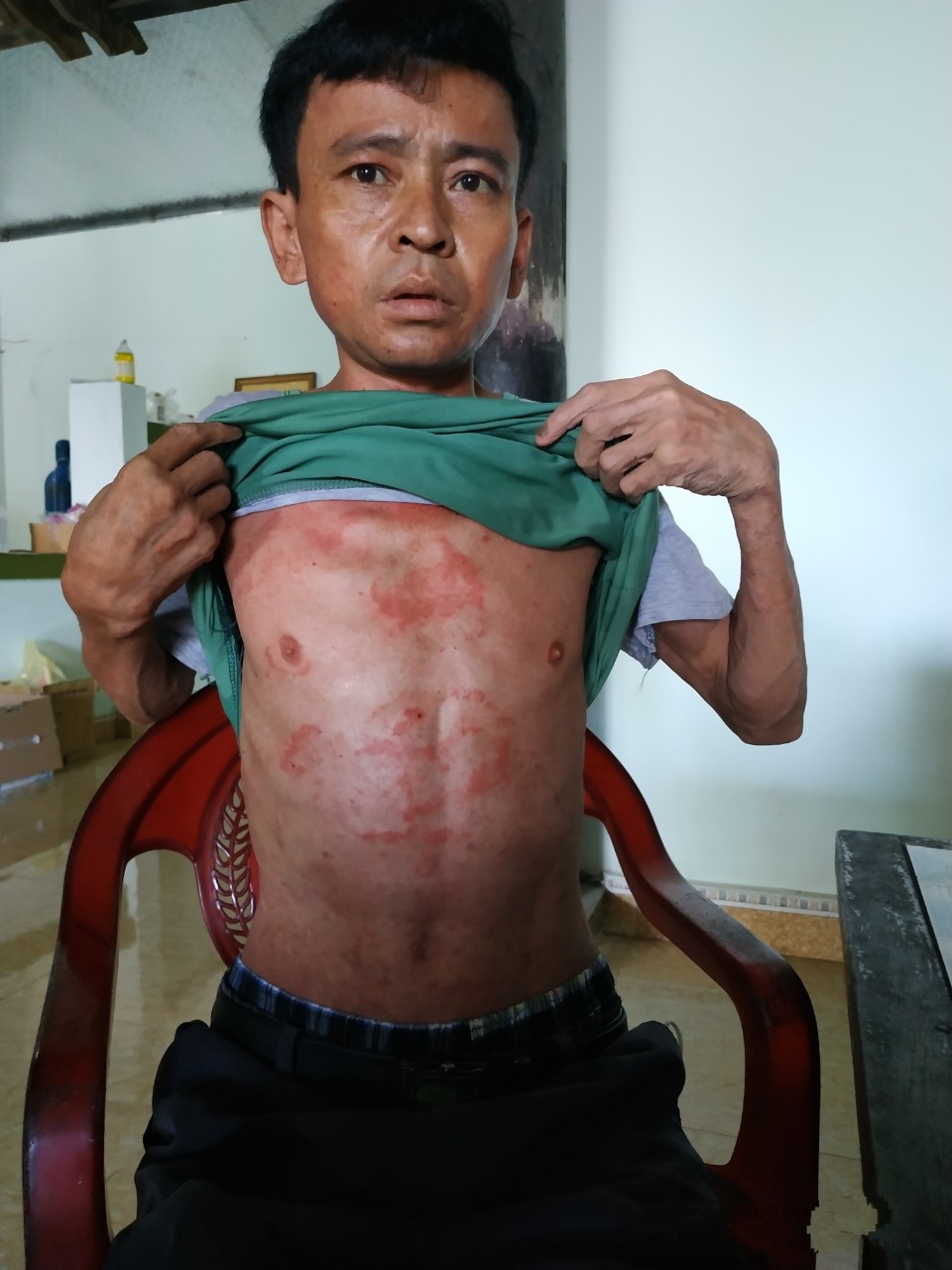 Vết gợn gia đình da cam sống quay quắt với cả tá bệnh hiểm nghèo - 3